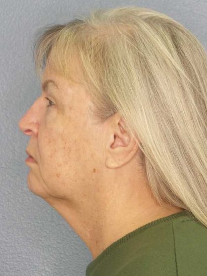 Facelift Before & After Patient #11842