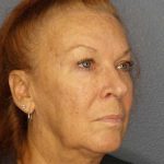 Facelift Before & After Patient #11767