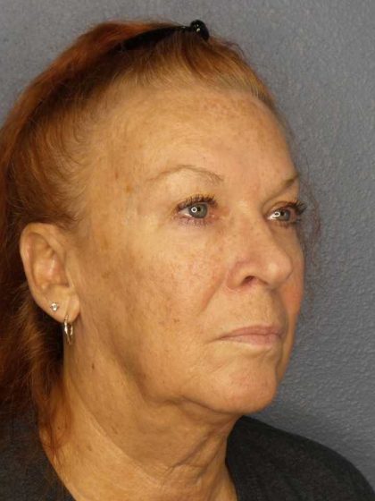 Facelift Before & After Patient #11767