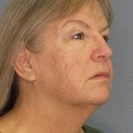Facelift Before & After Patient #11842