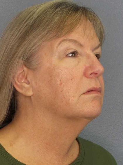Facelift Before & After Patient #11842