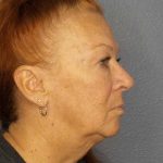 Facelift Before & After Patient #11767