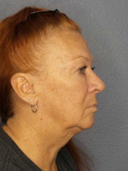 Facelift Before & After Patient #11767