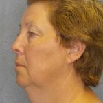 Facelift Before & After Patient #7556