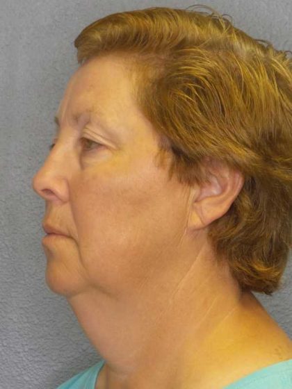 Facelift Before & After Patient #7556
