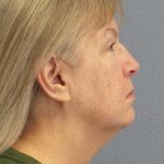 Facelift Before & After Patient #11842
