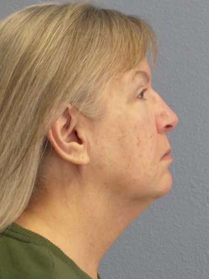 Facelift Before & After Patient #11842