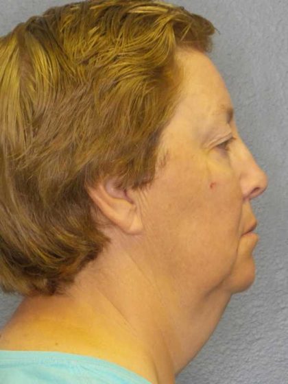 Facelift Before & After Patient #7556