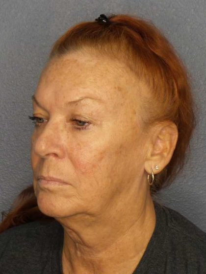 Facelift Before & After Patient #11767