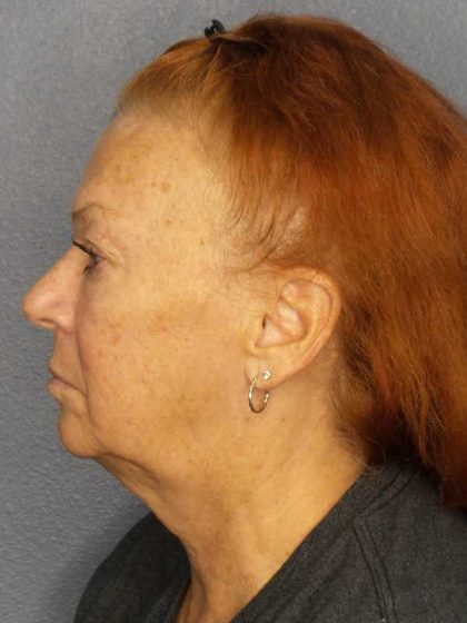 Facelift Before & After Patient #11767