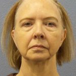 Facelift Before & After Patient #7515