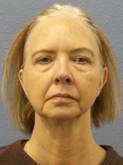 Facelift Before & After Patient #7515