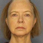 Facelift Before & After Patient #7515