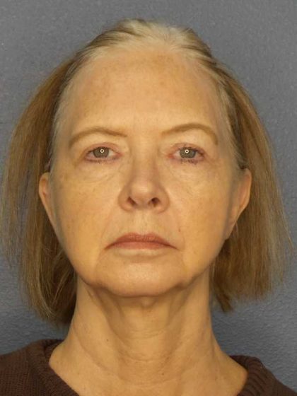 Facelift Before & After Patient #7515