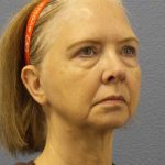 Facelift Before & After Patient #7515