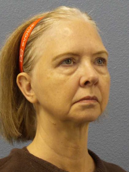 Facelift Before & After Patient #7515