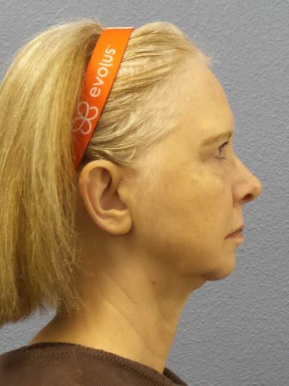 Facelift Before & After Patient #7515