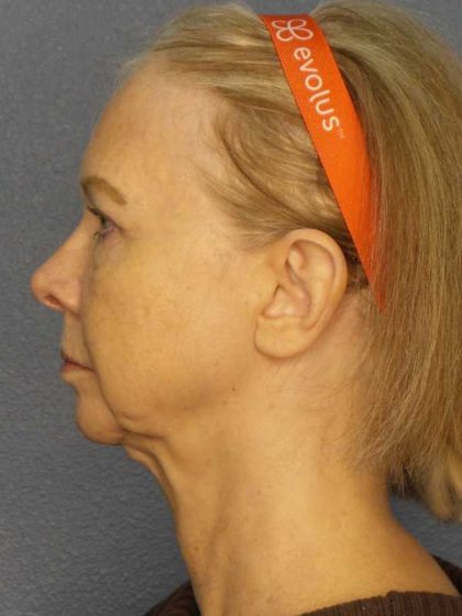 Facelift Before & After Patient #7515