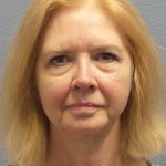 Facelift Before & After Patient #7515