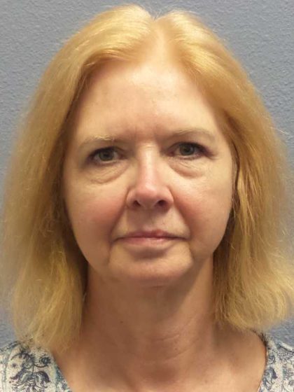 Facelift Before & After Patient #7515