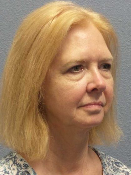 Facelift Before & After Patient #7515