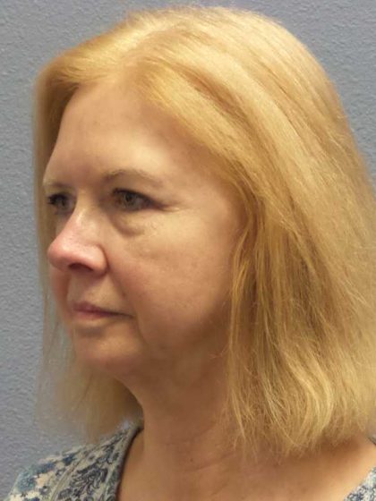 Facelift Before & After Patient #7515
