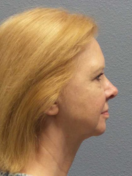 Facelift Before & After Patient #7515
