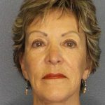 Facelift Before & After Patient #11781