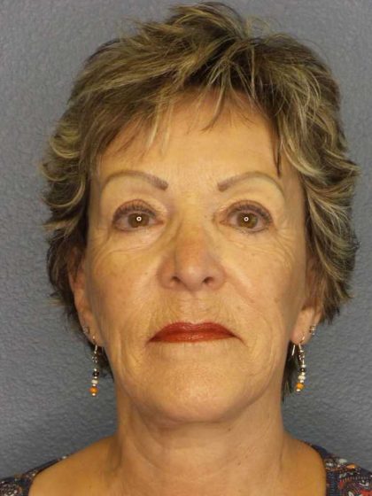 Facelift Before & After Patient #11781