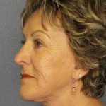 Facelift Before & After Patient #11781
