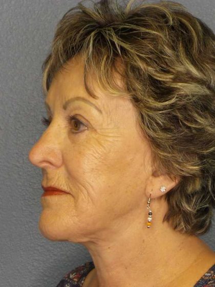 Facelift Before & After Patient #11781