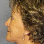 Facelift Before & After Patient #11781