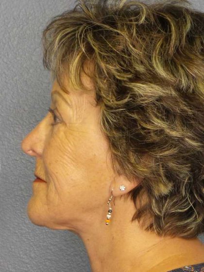 Facelift Before & After Patient #11781
