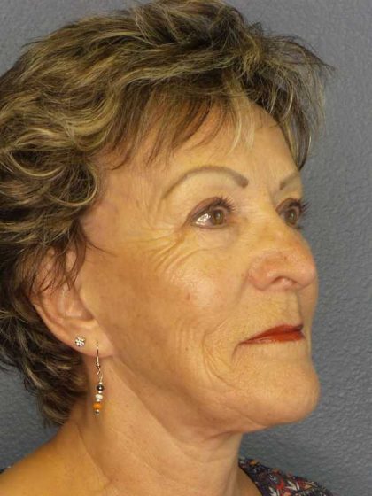 Facelift Before & After Patient #11781