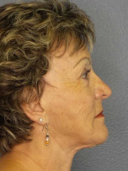 Facelift Before & After Patient #11781