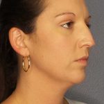 Liposuction of the Neck Before & After Patient #12203