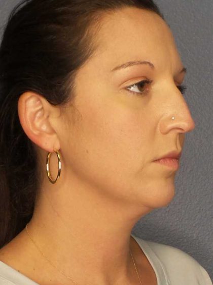 Liposuction of the Neck Before & After Patient #12203