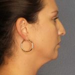 Liposuction of the Neck Before & After Patient #12203