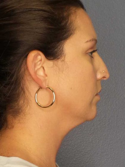 Liposuction of the Neck Before & After Patient #12203