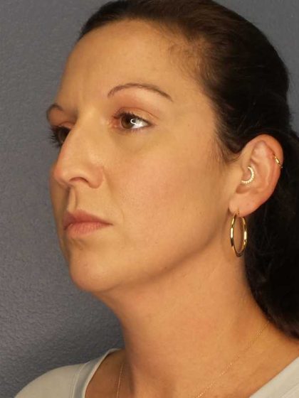 Liposuction of the Neck Before & After Patient #12203