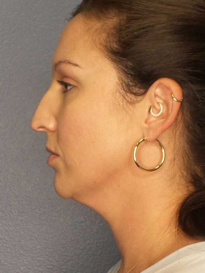 Liposuction of the Neck Before & After Patient #12203