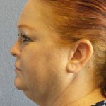 Liposuction of the Neck Before & After Patient #12060