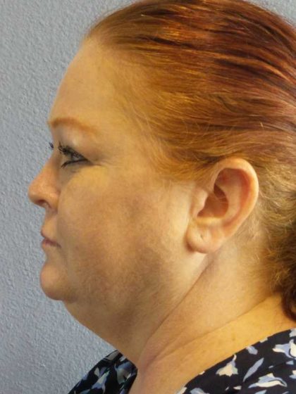 Liposuction of the Neck Before & After Patient #12060