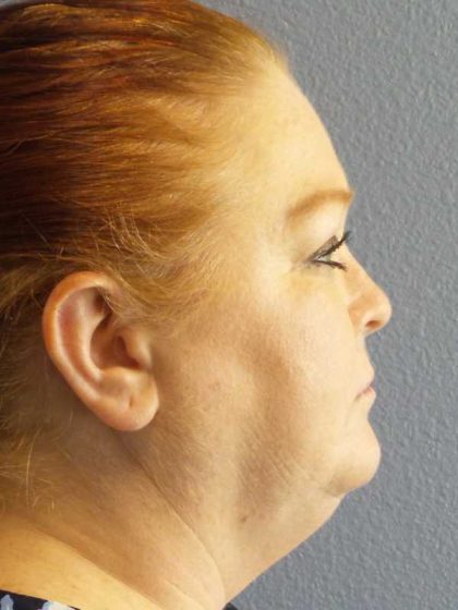 Liposuction of the Neck Before & After Patient #12060