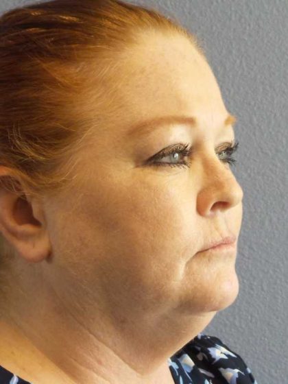 Liposuction of the Neck Before & After Patient #12060