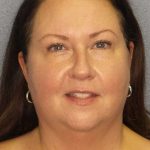 Liposuction of the Neck Before & After Patient #12104