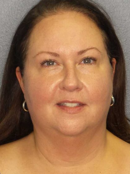 Liposuction of the Neck Before & After Patient #12104