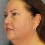 Liposuction of the Neck Before & After Patient #12104