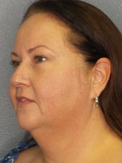 Liposuction of the Neck Before & After Patient #12104