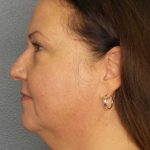 Liposuction of the Neck Before & After Patient #12104